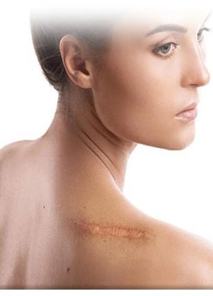 بخاخ مزيل الندبات