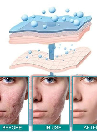 بخاخ مزيل الندبات