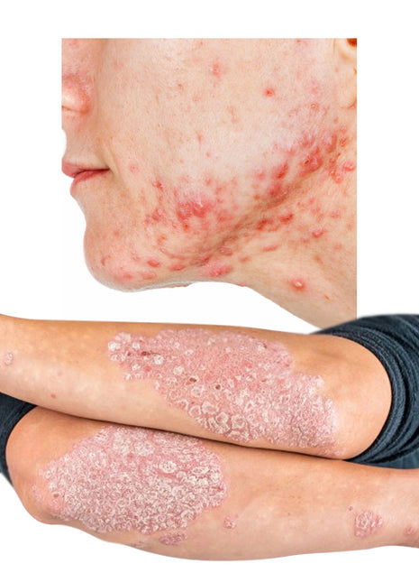 كريم لعلاج الصدفية والأكزيما بالأعشاب الطبيعية