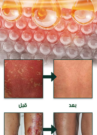 كريم لعلاج الصدفية والأكزيما بالأعشاب الطبيعية
